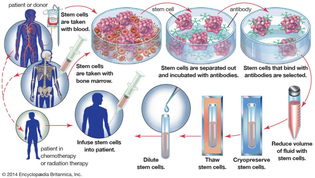 Autologous Transplant Bone Marrow Transplantation Britannica - Vaccination Schedule After Bone Marrow Transplant