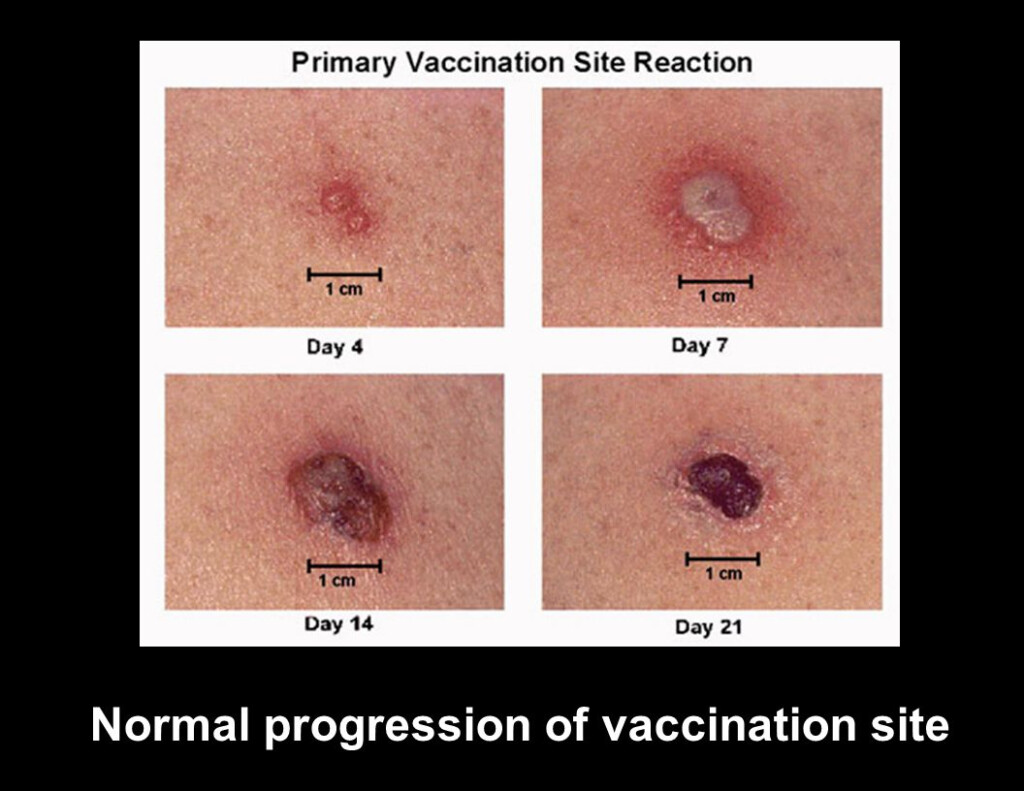 BCG Vaccination Pakenham Medical Clinic - Bcg Vaccine Dose Schedule